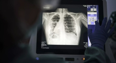  Verem Dünyanın En Ölümcül Bulaşıcı Hastalığı Olarak Geri Döndü: Araştırma Sonuçları Ne Anlatıyor?